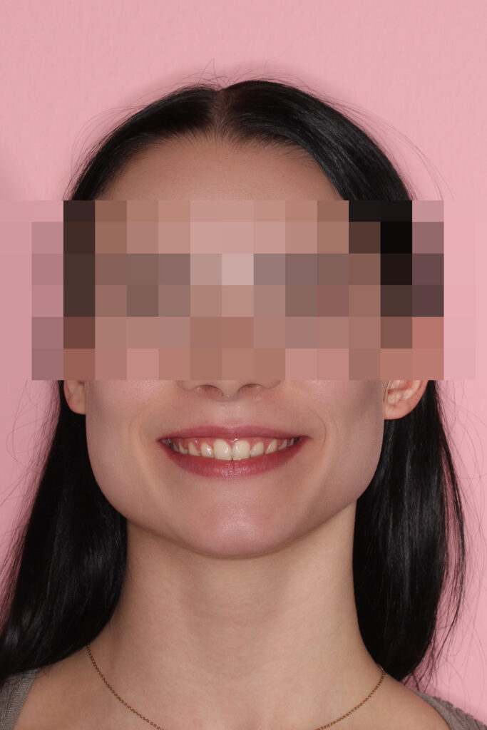 Festsitzende Zahnspange bei Tiefbiss und Gummy Smile: Lächeln frontal nach der Behandlung