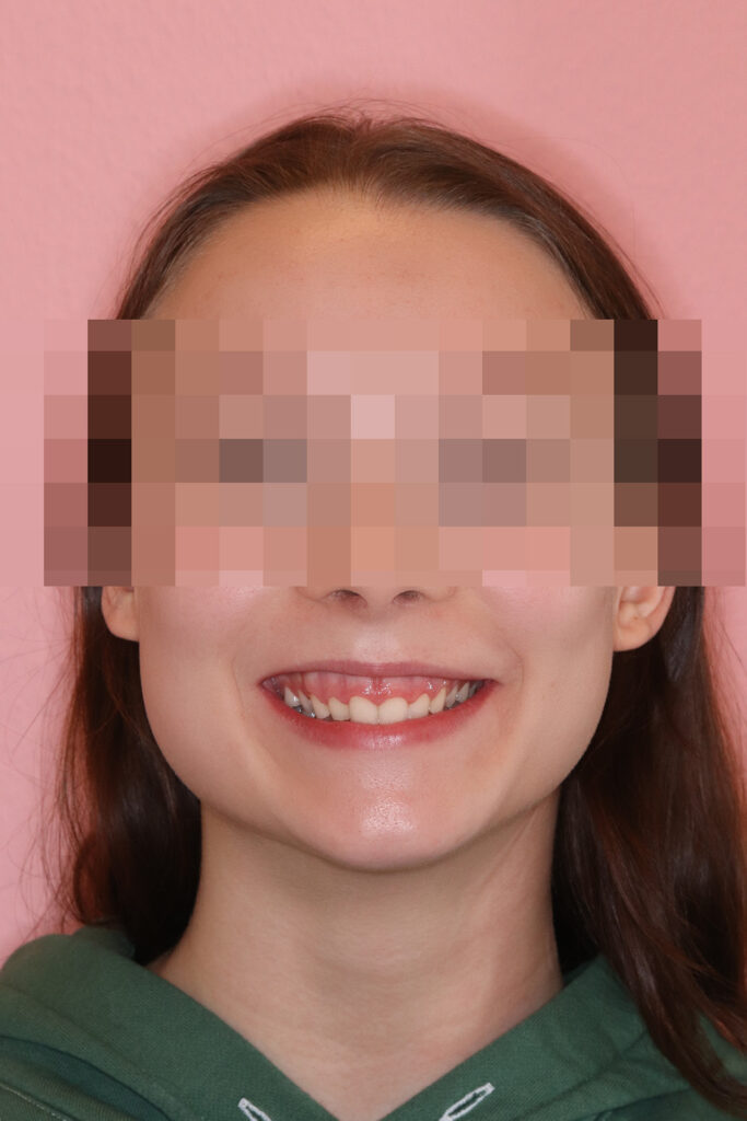 Festsitzende Zahnspange bei Tiefbiss und Gummy Smile: Lächeln frontal vor der Behandlung