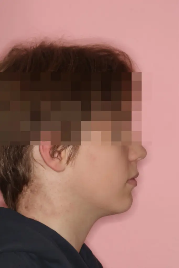 Kieferorthopädie und Kieferchirurgie: Seitenprofil nach der operativen Vorverlagerung des Unterkiefers