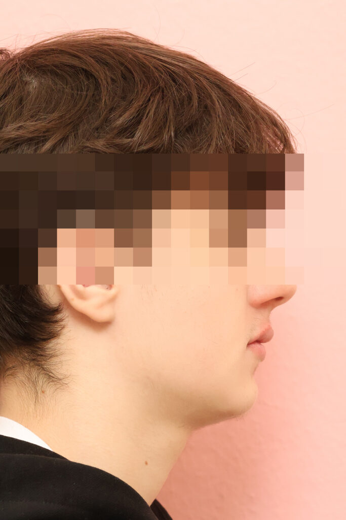 Unterkiefervorverlagerung ohne Operation: harmonisiertes Seitenprofil nach der Behandlung