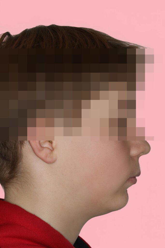 Kieferorthopädie und Kieferchirurgie: Seitenprofil mit zu kurzem Unterkiefer vor der Behandlung