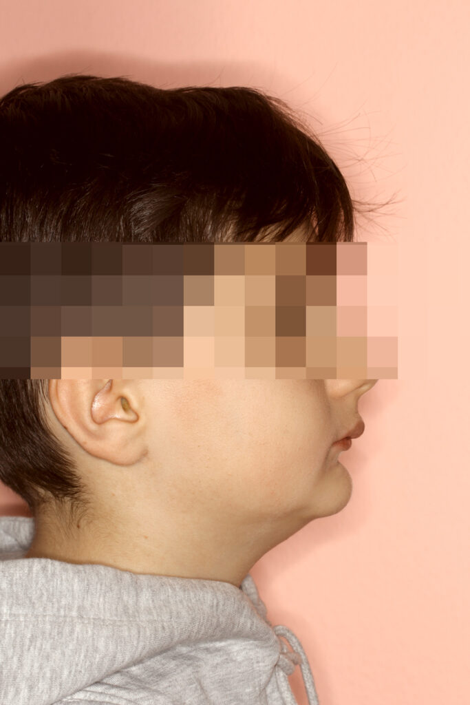 Unterkiefervorverlagerung ohne Operation: Seitenprofil vor der Behandlung