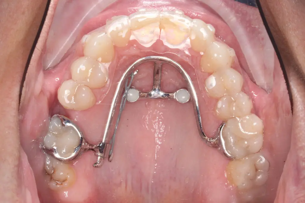 Aligner in Kombination mit festsitzenden unsichtbaren Apparaturen